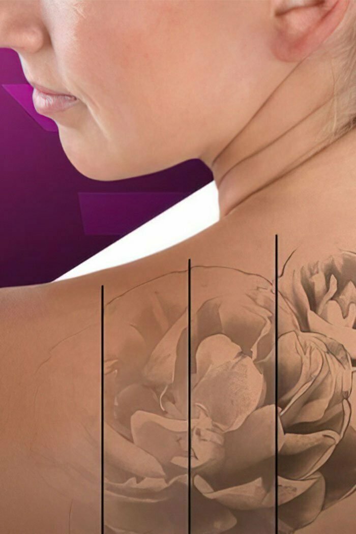 What is nonlaser tattoo removal