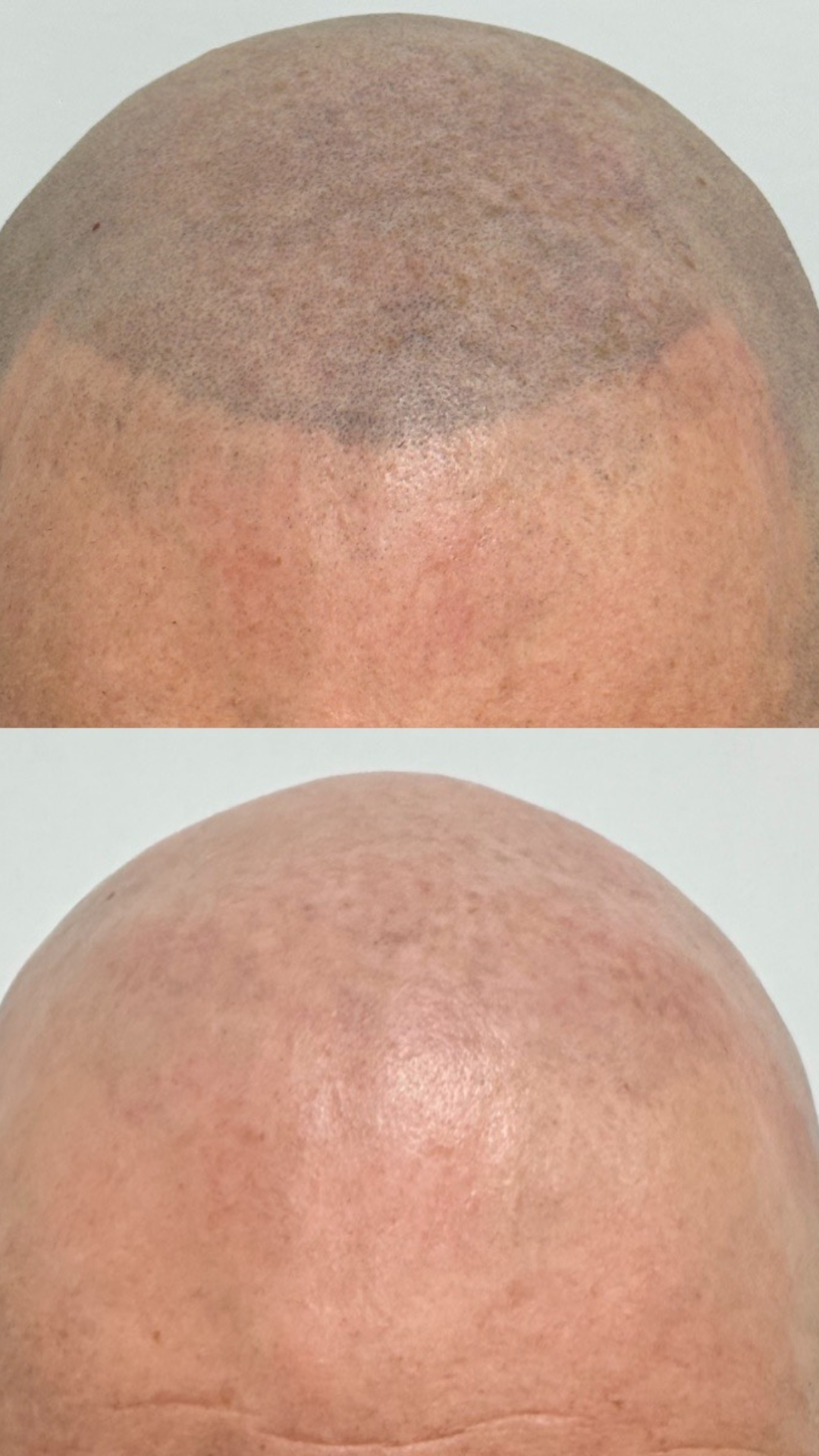 SMP removal in Birmingham