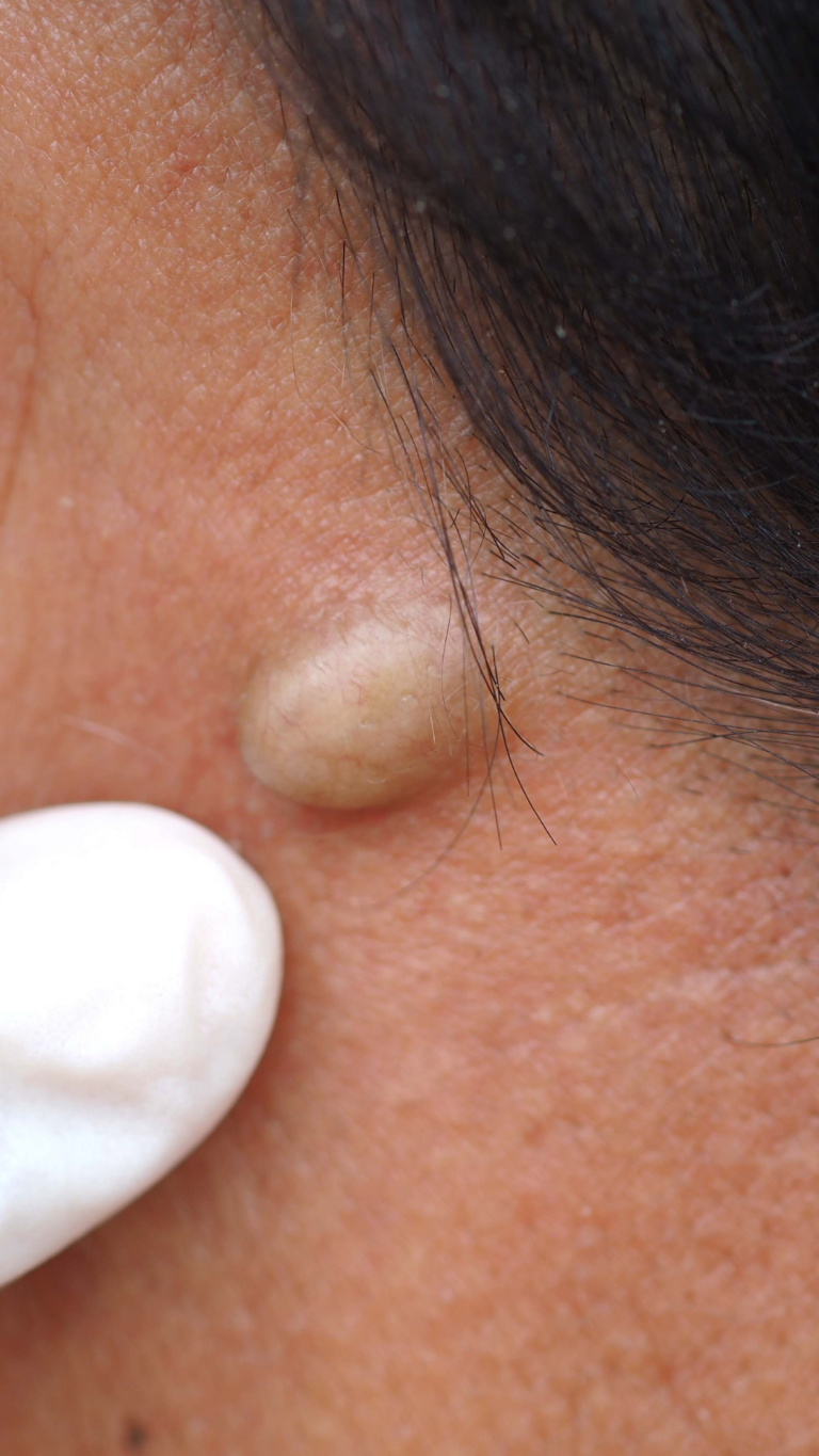 Skin Cyst Removal