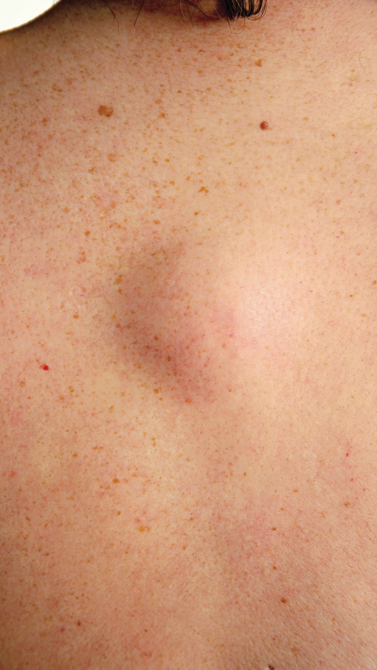 Lipoma Removal in Sutton Coldfield