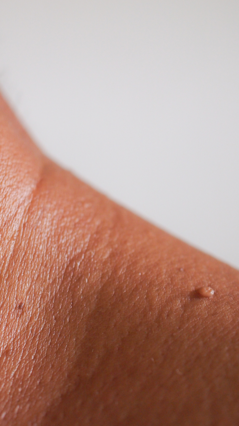 Skin Tag Removal in Sutton Coldfield