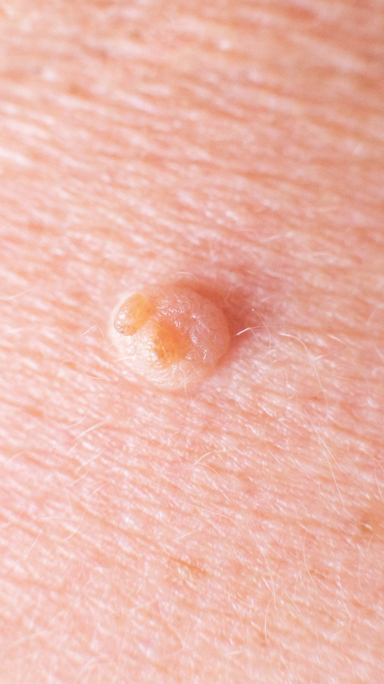 Wart Removal in Birmingham