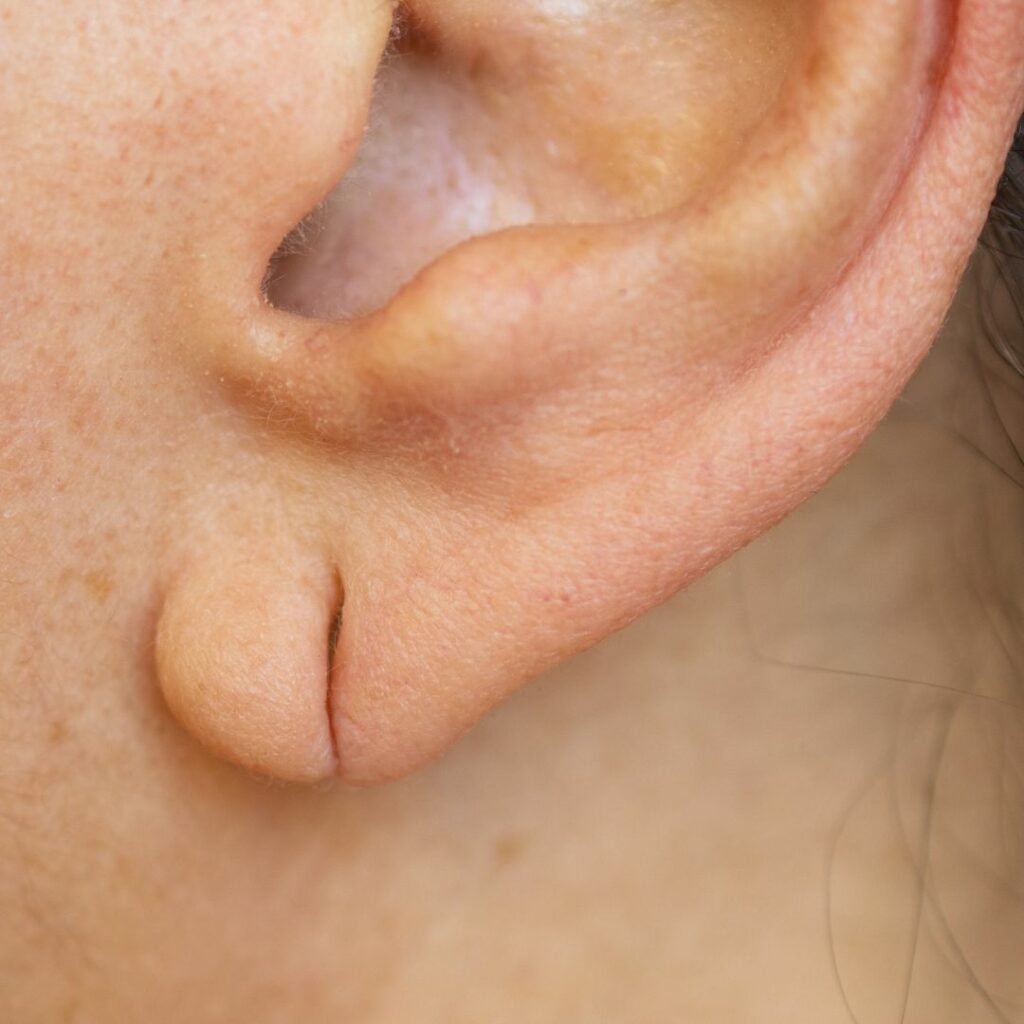Earlobe Repair
