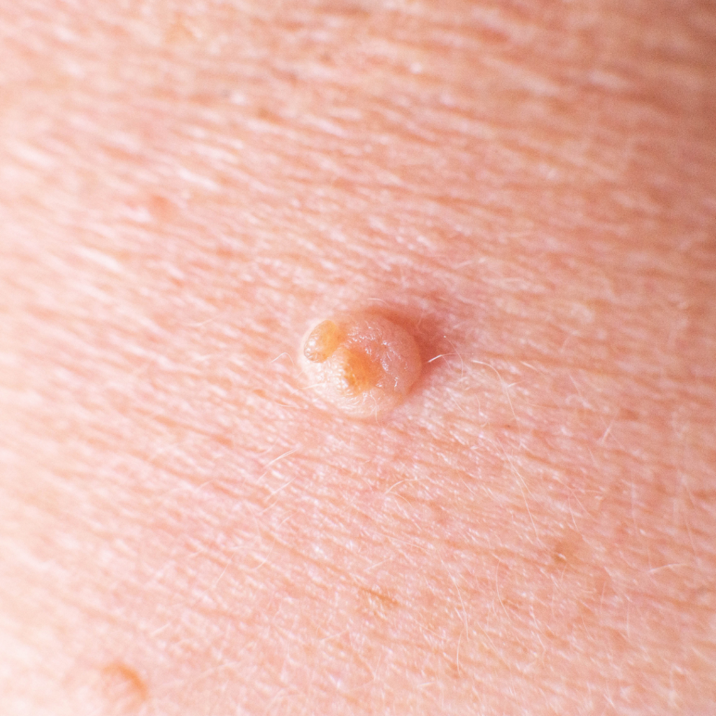 Wart Removal