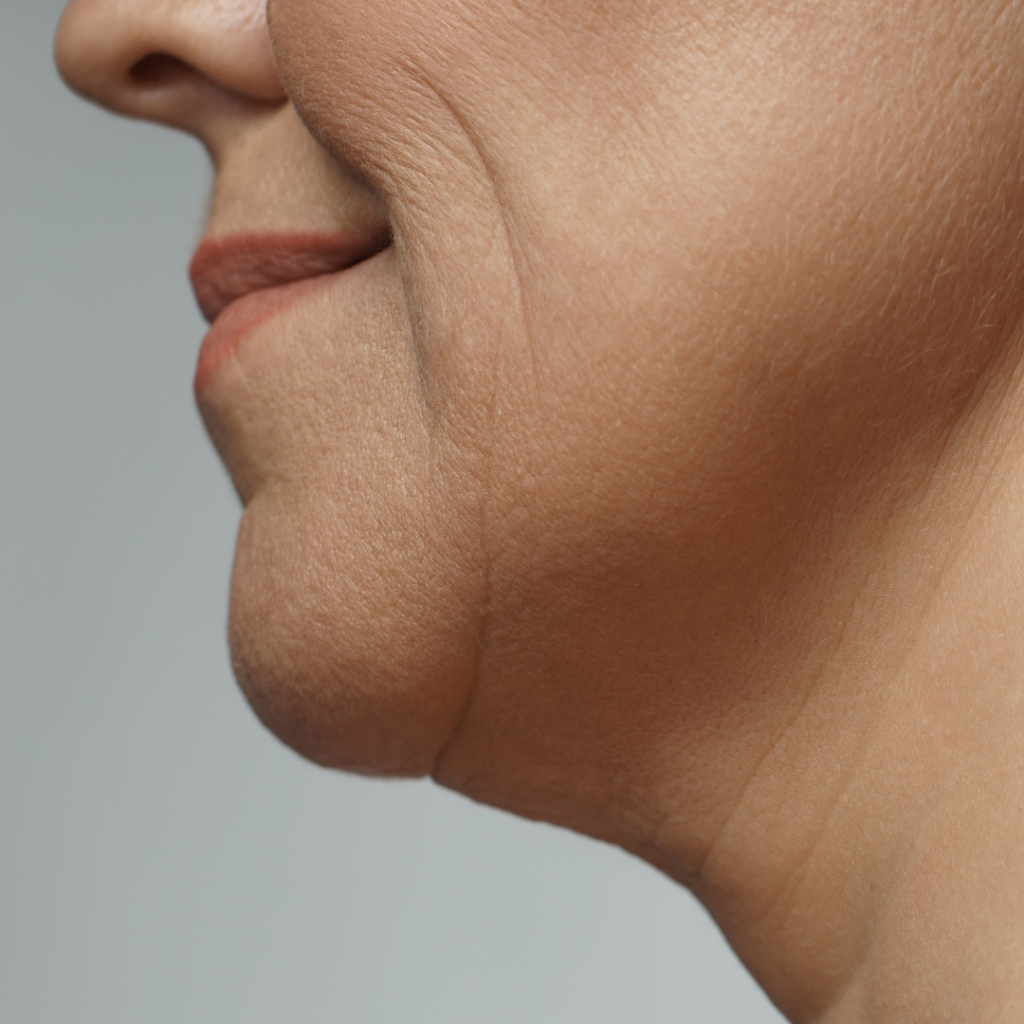 Neck Lift