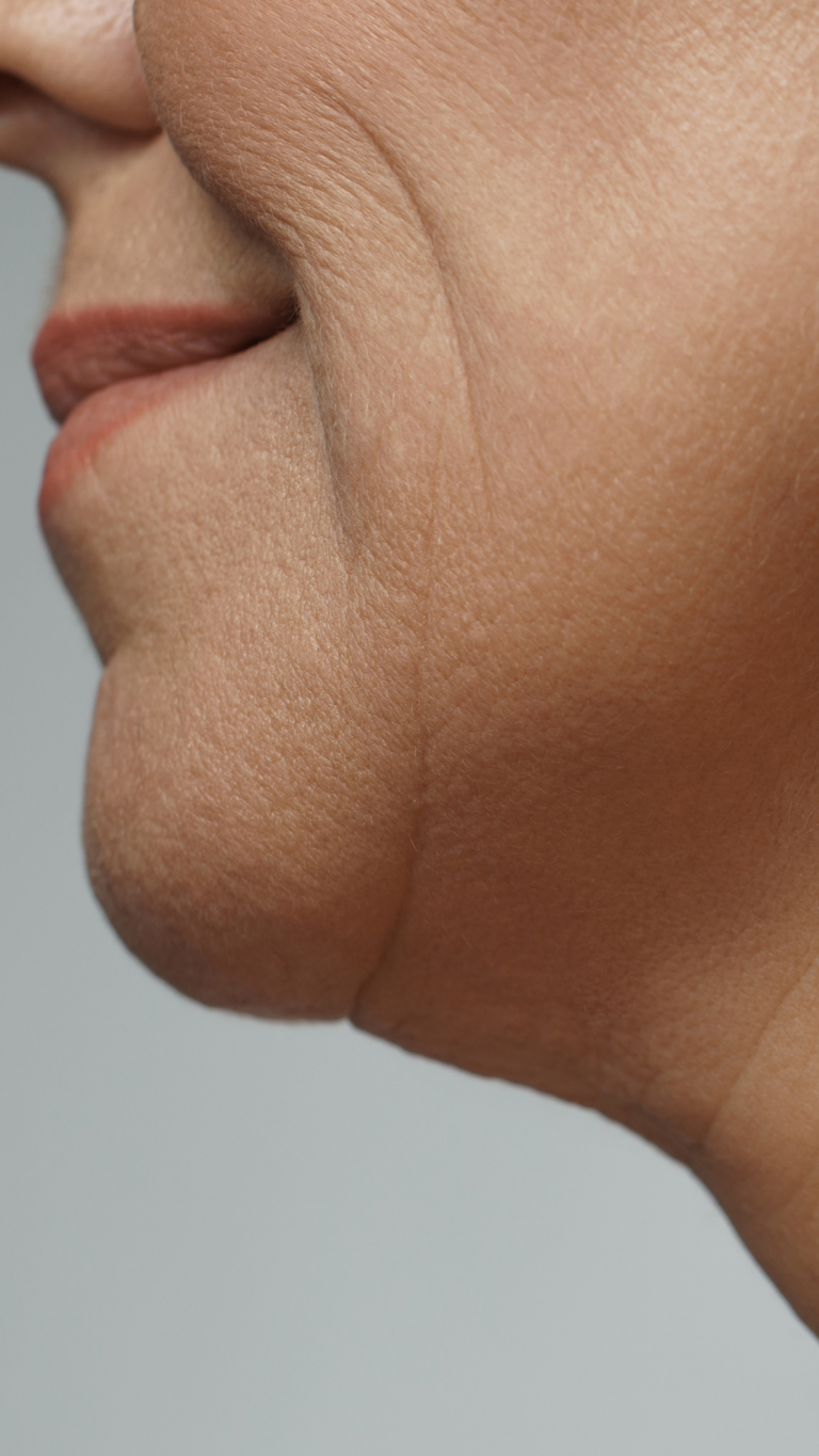 Neck Lift Surgery