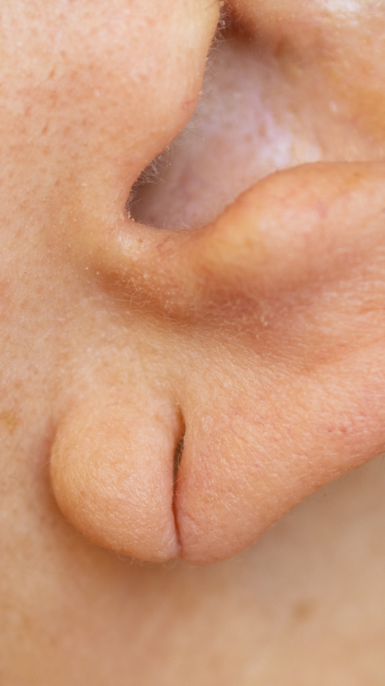 Earlobe repair surgery