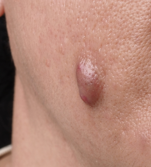 Skin Cyst Removal Birmingham Skin Cyst Removal in Birmingham
