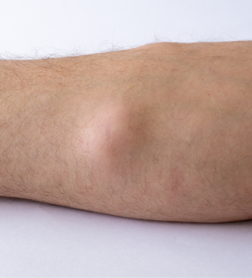 Lipoma removal in Birmingham Lipoma removal surgery in Birmingham