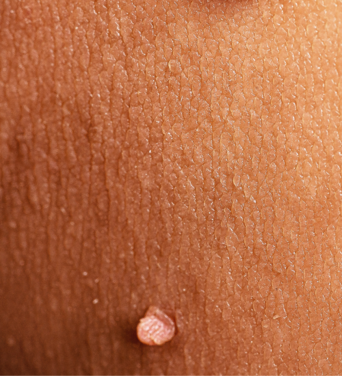Skin Tag Removal Treatments Skin Tag Removal Treatments