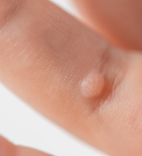 Wart Removal Treatment Wart Removal Treatment Sutton Coldfield