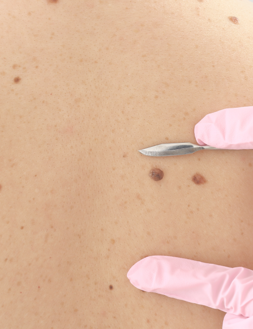 Mole Removal Mole Removal Birmingham
